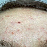 Cura di psoriasi in Buryatia
