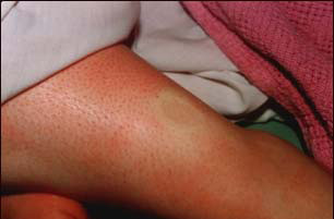 EDEMA