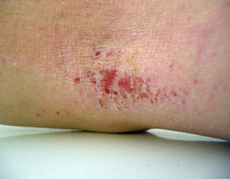 ECZEMA