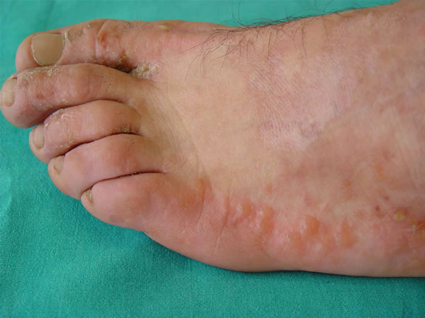 DISIDROSI